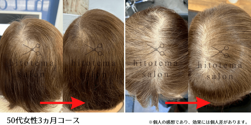 50代女性・3か月コース:髪が全体的にボリュームアップしています(hitotema salon施術結果)