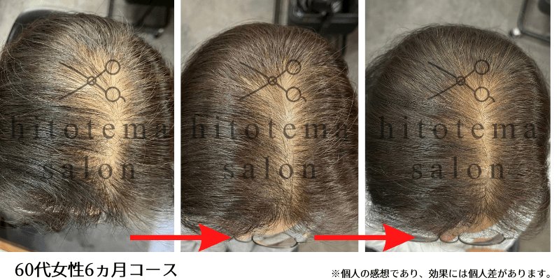 60代女性・6ヵ月経過:透けていた頭皮がしっかりカバーされています(女性専用育毛サロンの施術結果)