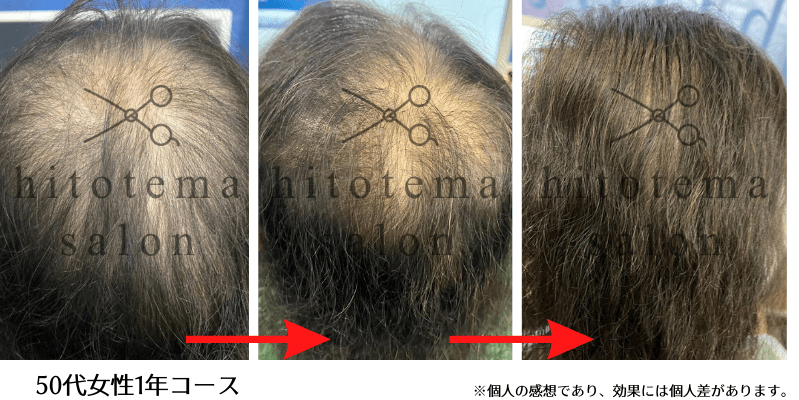 50代女性・1年コース:全体的に毛髪が密になってきております(hitotema salonの実績)