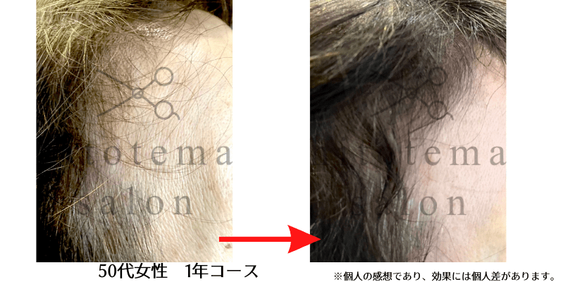 50代女性・1年コース:髪の密度がしっかり増えています(大阪・hitotema salon施術結果)