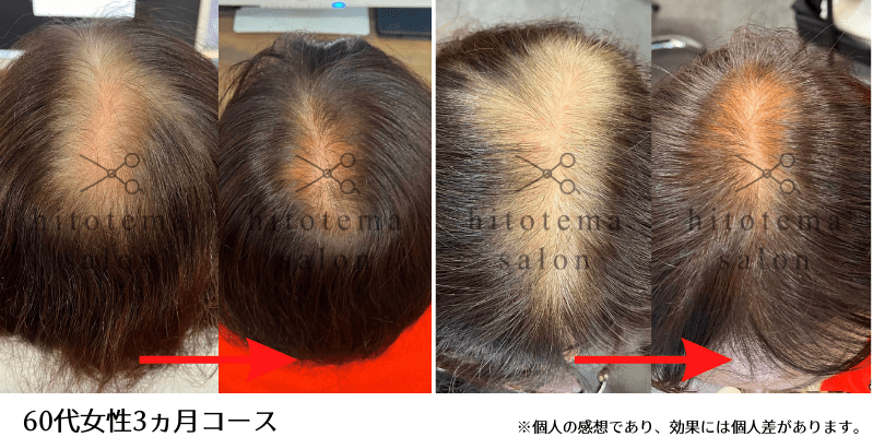 60代女性・3ヵ月経過 3カ月で毛量がアップしています(女性専用育毛サロンhitotema salonの施術結果)