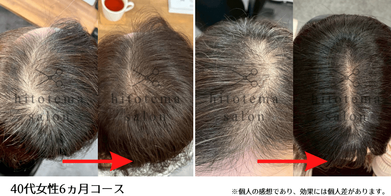 40代女性・6ヵ月：集中コース6ヵ月全体的に頭皮の透けがへりました！