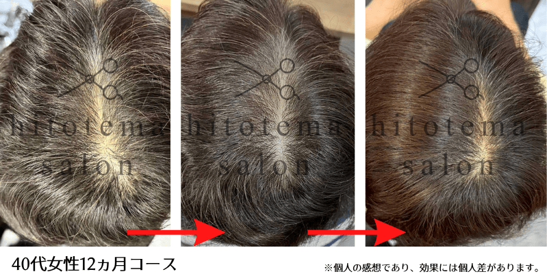 40代女性・12ヵ月：分け目の透けがなくなりました