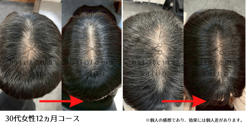 30代女性・12ヵ月:12か月前と比べて頭皮が見えなくなっています(育毛スパ施術例)