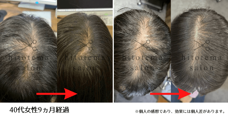 40代女性のビフォーアフター頭頂部が密になっているのが分かります。