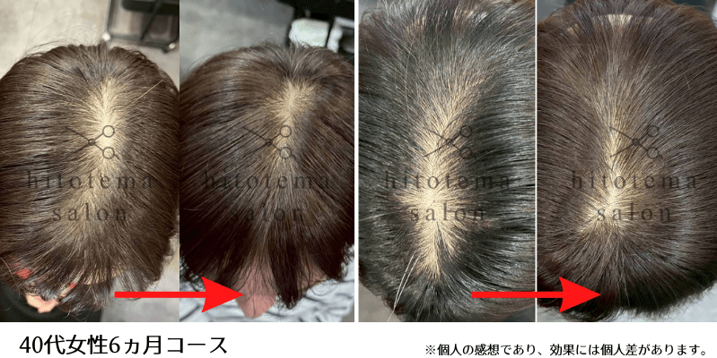 頭頂部の髪の毛が濃くなってきております。40代女性ビフォーアフター