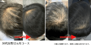 30代女性の1年間の施術結果です。髪の流れが整い、頭頂部に自然な厚みが感じられるようになっています。