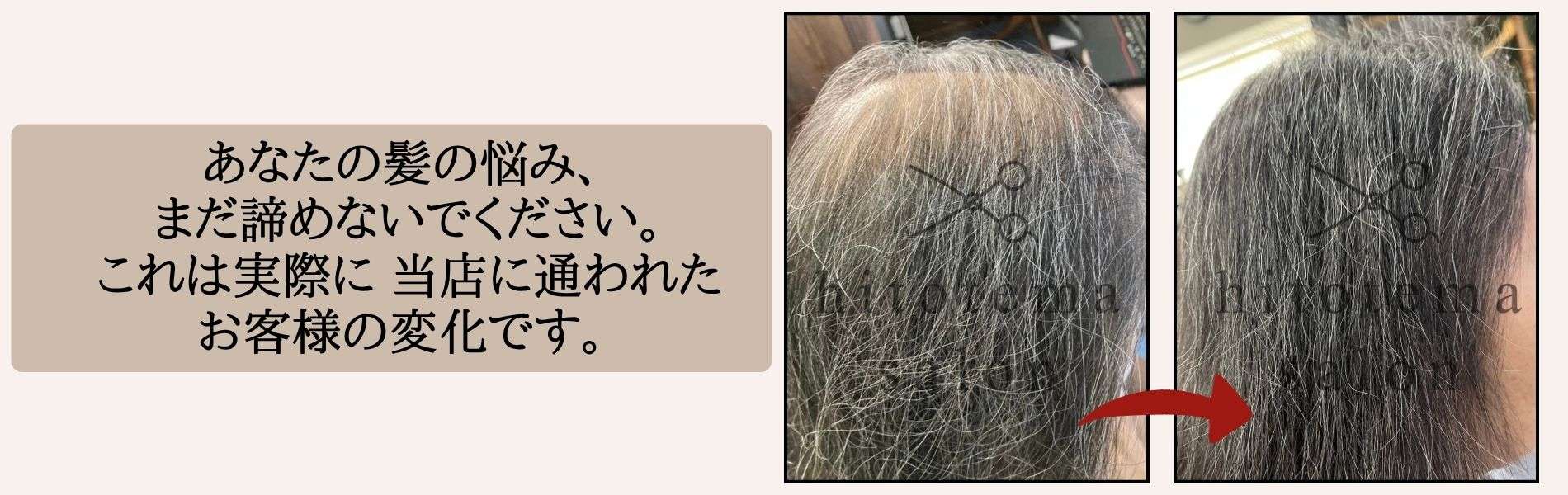 hitotema salonで施術を受けたお客様の成果です。全体的に髪のボリュームがでてきております。