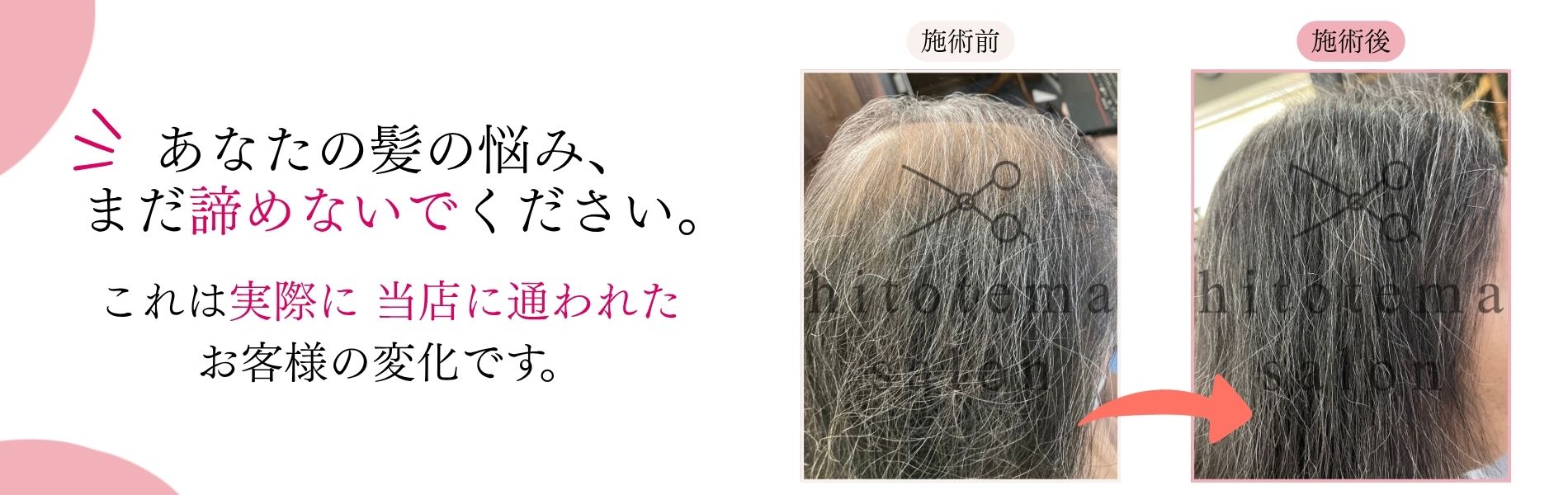hitotema salonで施術を受けたお客様の成果です。全体的に髪のボリュームがでてきております。