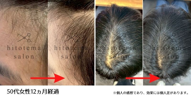 50代女性のお客様の施術結果 12ヵ月経過した時のお写真になります。こめかみも頭頂部も良い感じに増えてきております。