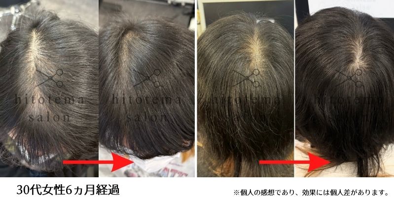 30代女性のお客様の施術結果 6ヵ月経過した時のお写真です。後頭部、頭頂部の毛量が増えてきております。