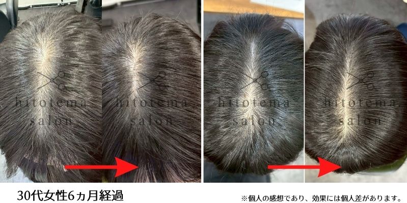 30代女性の施術結果になります6ヵ月経過した時のお写真になります。頭頂部が密になってきております。