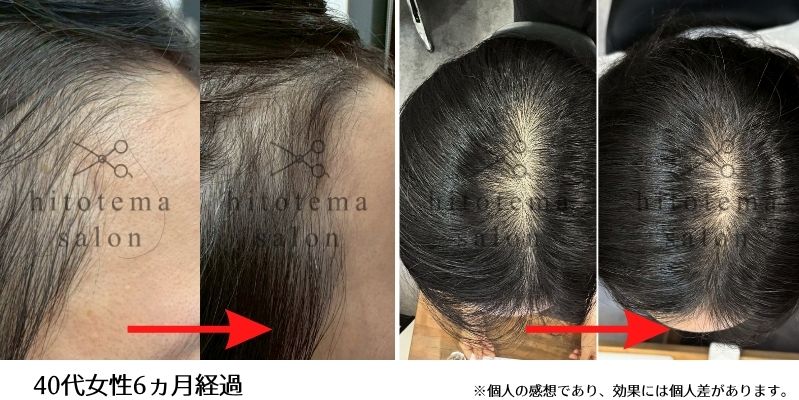 40代女性のお客様の施術結果 6ヵ月経過時のお写真になります。こめかみも頭頂部も密になってきております。