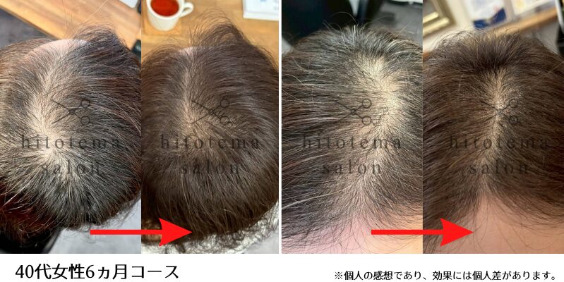 40代女性・6ヵ月：集中コース6ヵ月全体的に頭皮の透けがへりました！