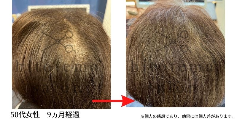 50代女性・9ヵ月経過のお写真です。後頭部の頭皮の透けがへりました！