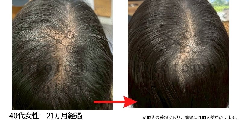 40代女性・21ヵ月経過です写真頭頂部が密になってきております！
