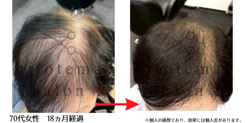 70代女性・18ヵ月経過。全体的に頭皮の透けがへりました！