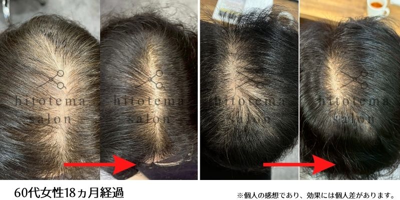 60代女性・18ヵ月経過のお写真になります。頭頂部の透けが無くなりました！