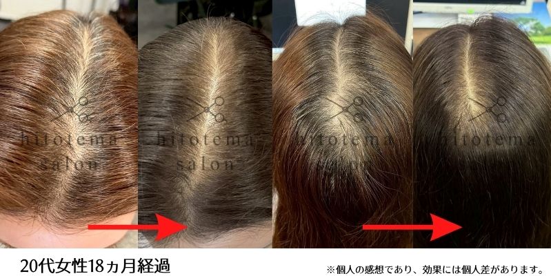 20代女性・18カ月経過。20代女性の薄毛・頭皮ケア18カ月経過の事例です。気になっていた分け目の頭皮が目立ちにくい印象に。女性の薄毛ケアによる変化を写真でご紹介します。