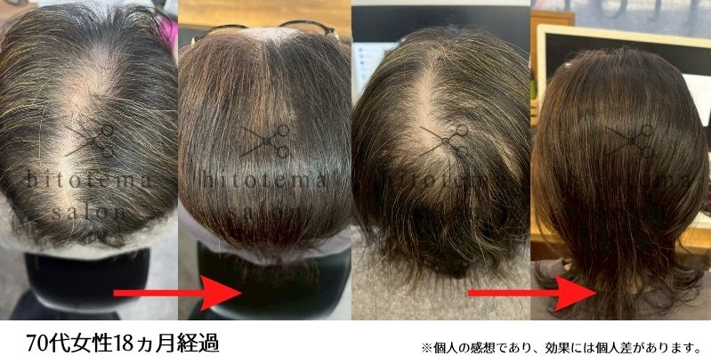 70代女性・18カ月経過。70代女性の薄毛・頭皮ケア18カ月経過の事例です。気になっていた頭頂部の透けが目立ちにくくなり、髪全体もふんわりとした印象に。写真で経過をご紹介します。