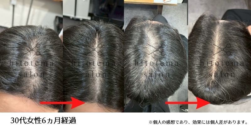 30代女性・6カ月経過。30代女性の薄毛・頭皮ケア6カ月経過の事例です。分け目の頭皮が目立ちにくくなり、髪全体も密な印象に。女性の薄毛ケアによる変化を写真でご覧いただけます。